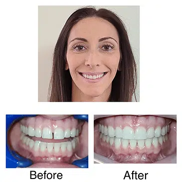 "Great staff. I just finished Invisalign and my teeth are perfection. I don't have migraines from my TMJ and my smile is flawwwwlesssssssss."