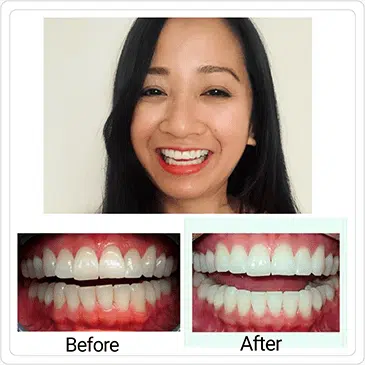 Raize: "I love my new smile. Invisalign at Cottage Dental was super easy."
